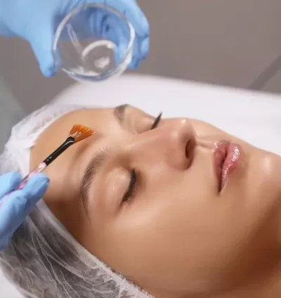 Chemical Peels