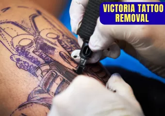 Victoria Tattoo Removal